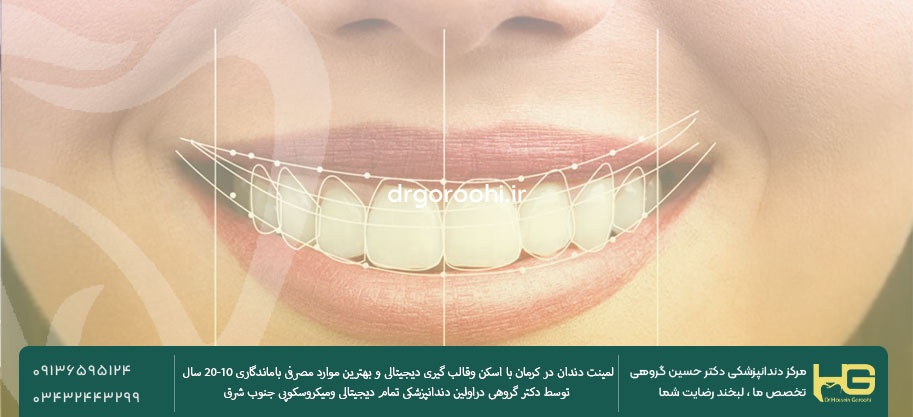 قیمت لمینت دندان در کرمان