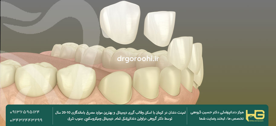 قیمت لمینیت لومینیرز در کرمان