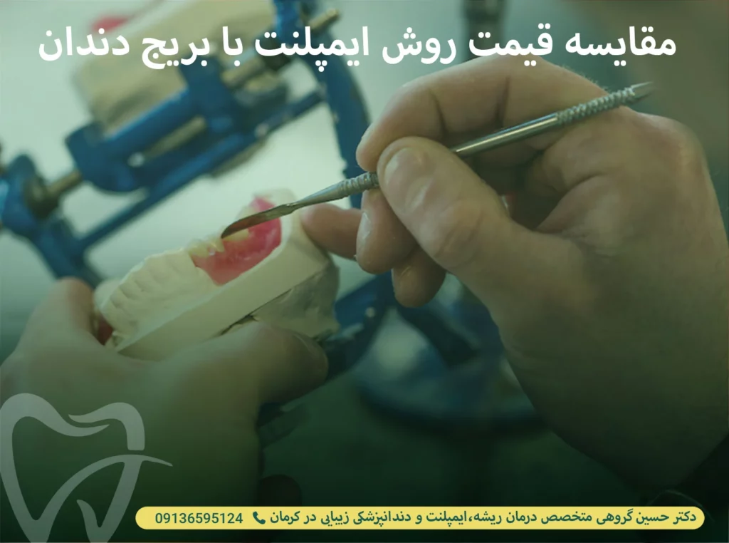 مقایسه قیمت روش ایمپلنت با بریج دندان