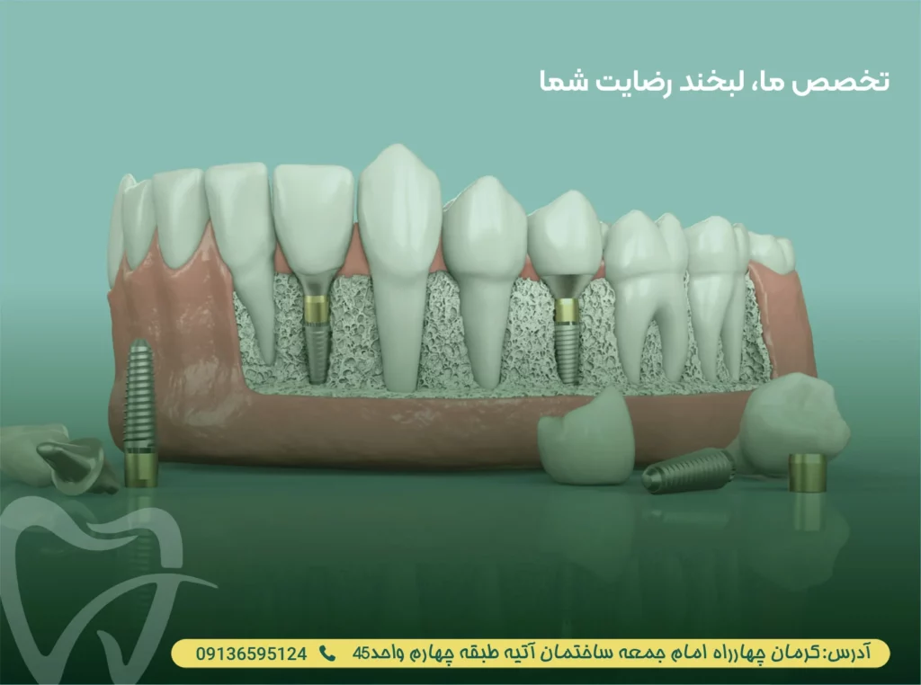 مزایای ایمپلنت آمریکایی