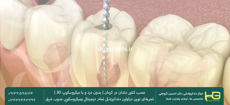 عصب کشی دندان در کرمان بدون درد