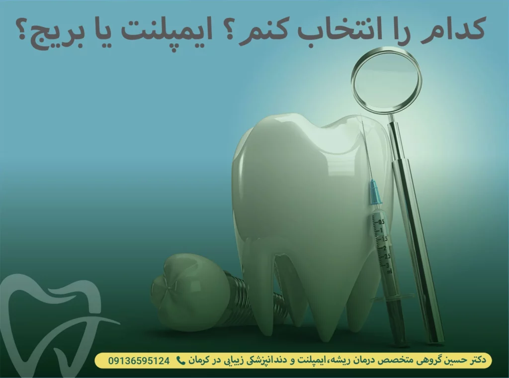 کدام را انتخاب کنم؟ایمپلنت یا بریج؟