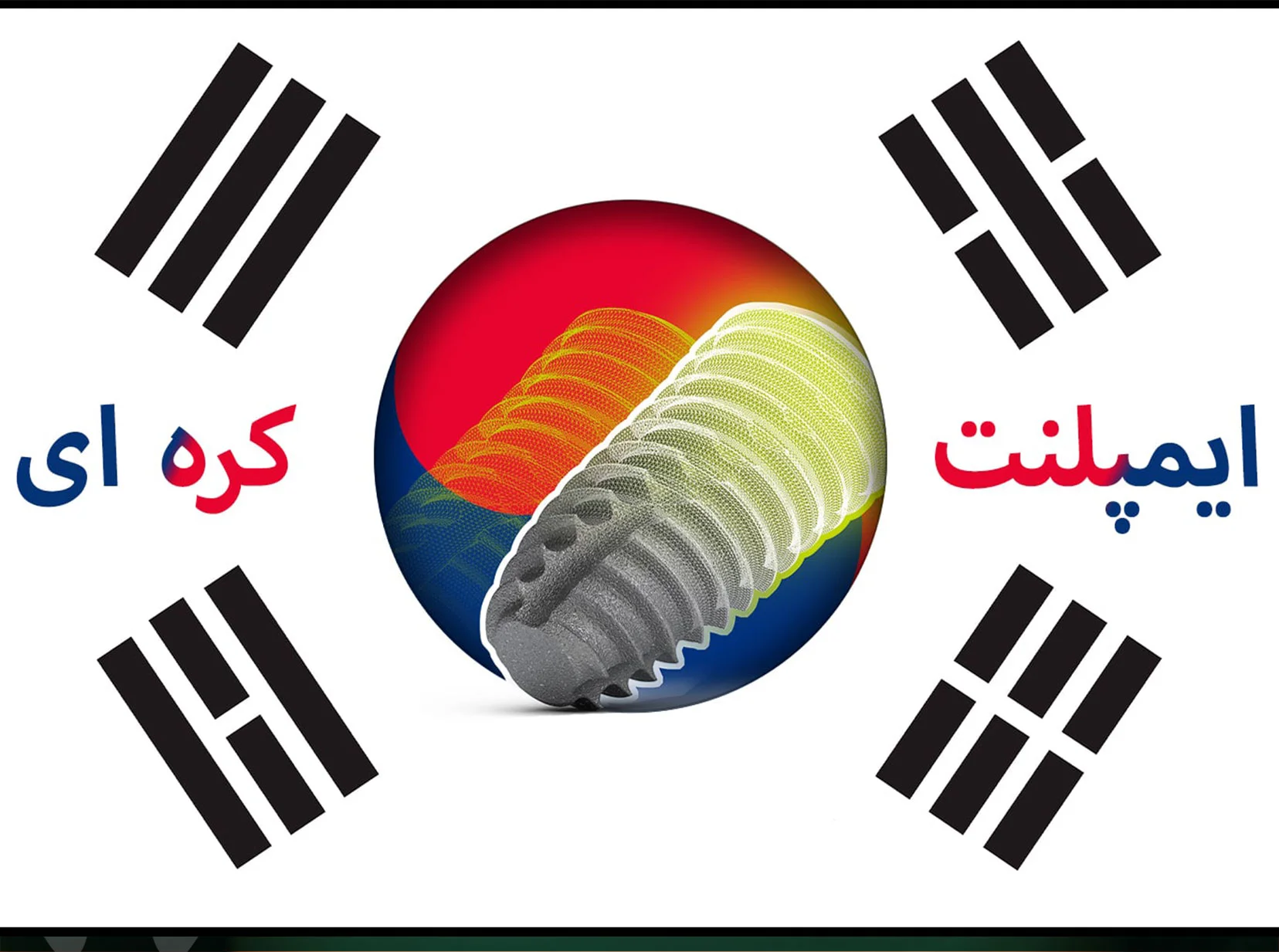 همه چیز درباره ی ایمپلنت کره ای