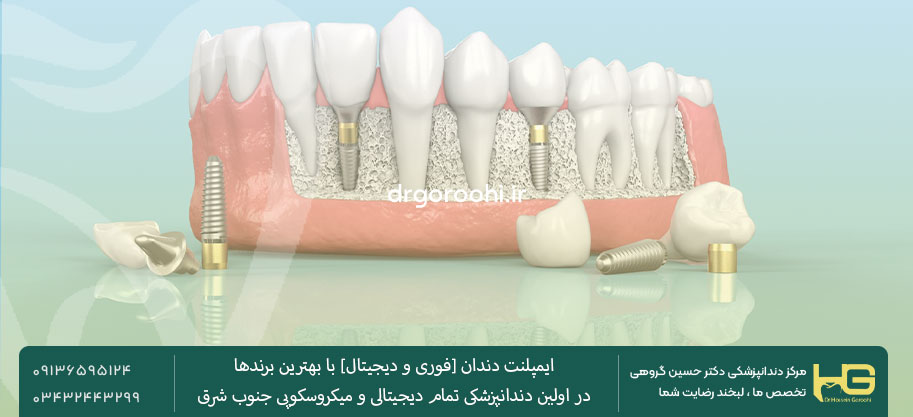 مزایای ایمپلنت سوئیسی