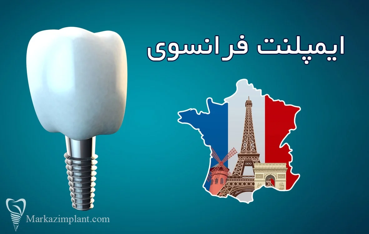 ایمپلنت فرانسوی