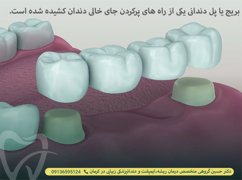 بریج دندان یکی از راه های پر کردن جای خالی دندان کشیده شده