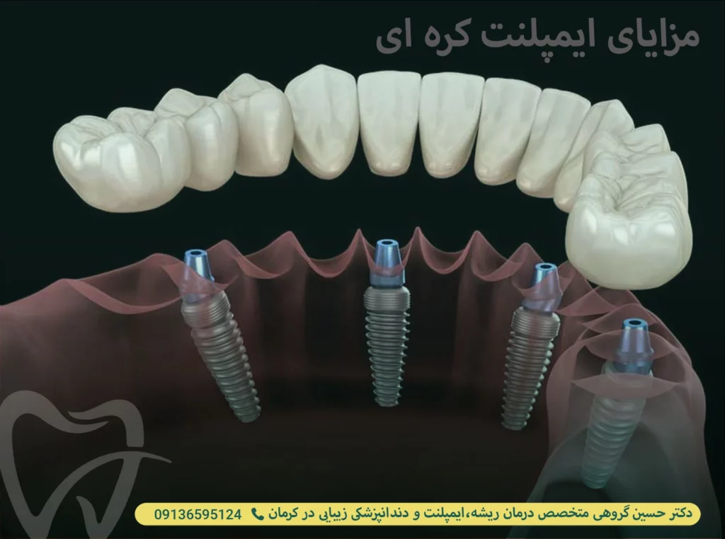 مزایای ایمپلنت کره ای