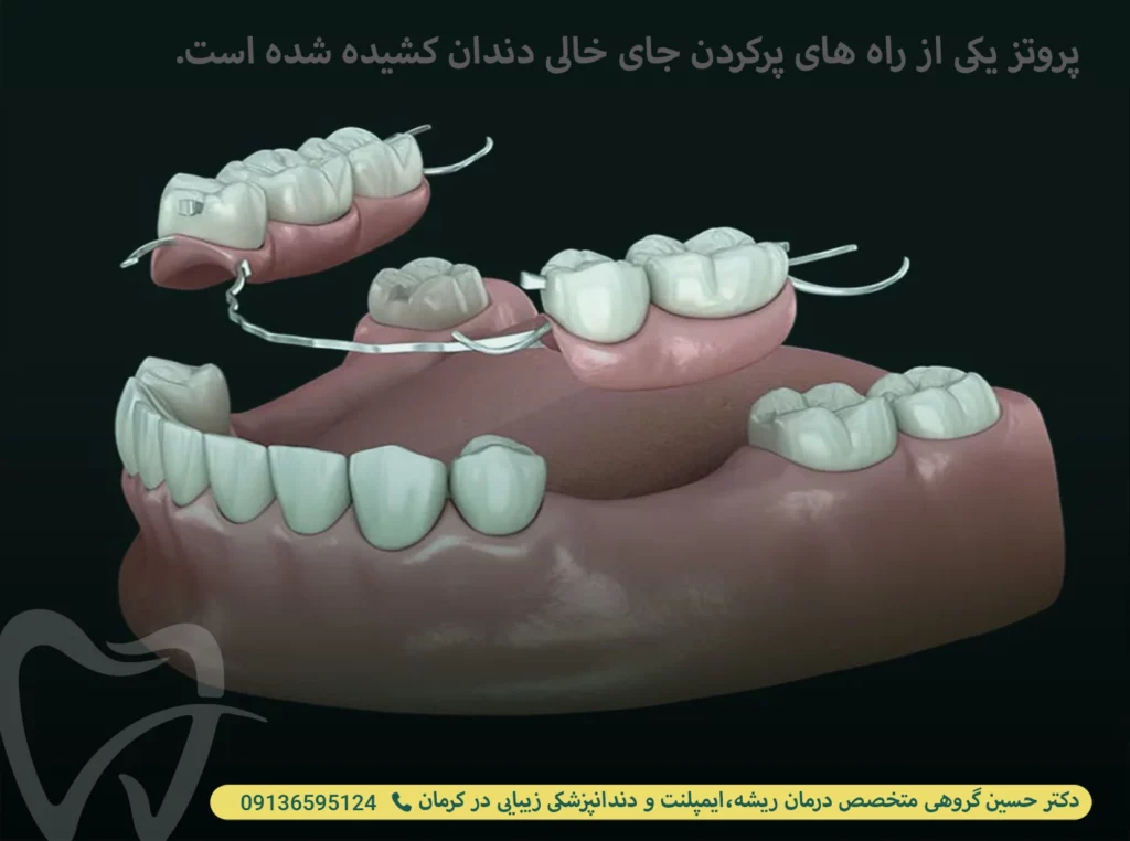 پروتز دندان یکی از راه های پر کردن جای خالی دندان کشیده شده