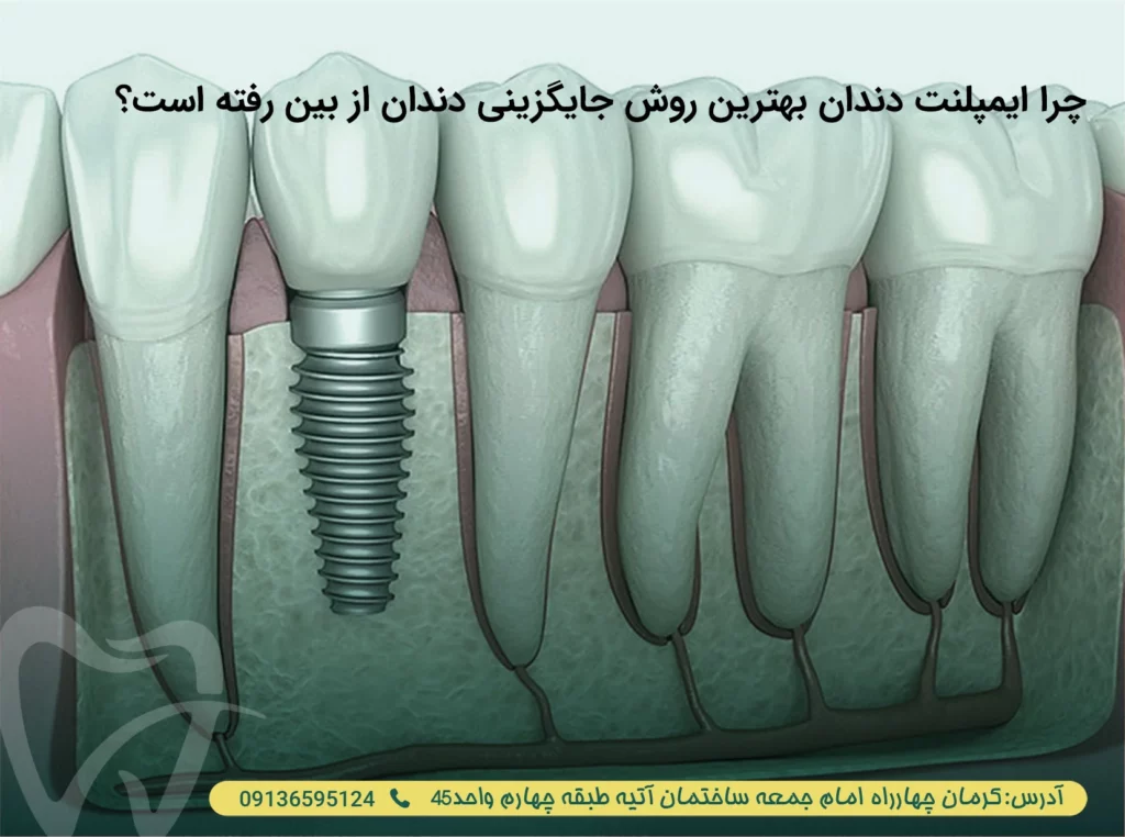 بهترین جایگزین دندان از دست رفته