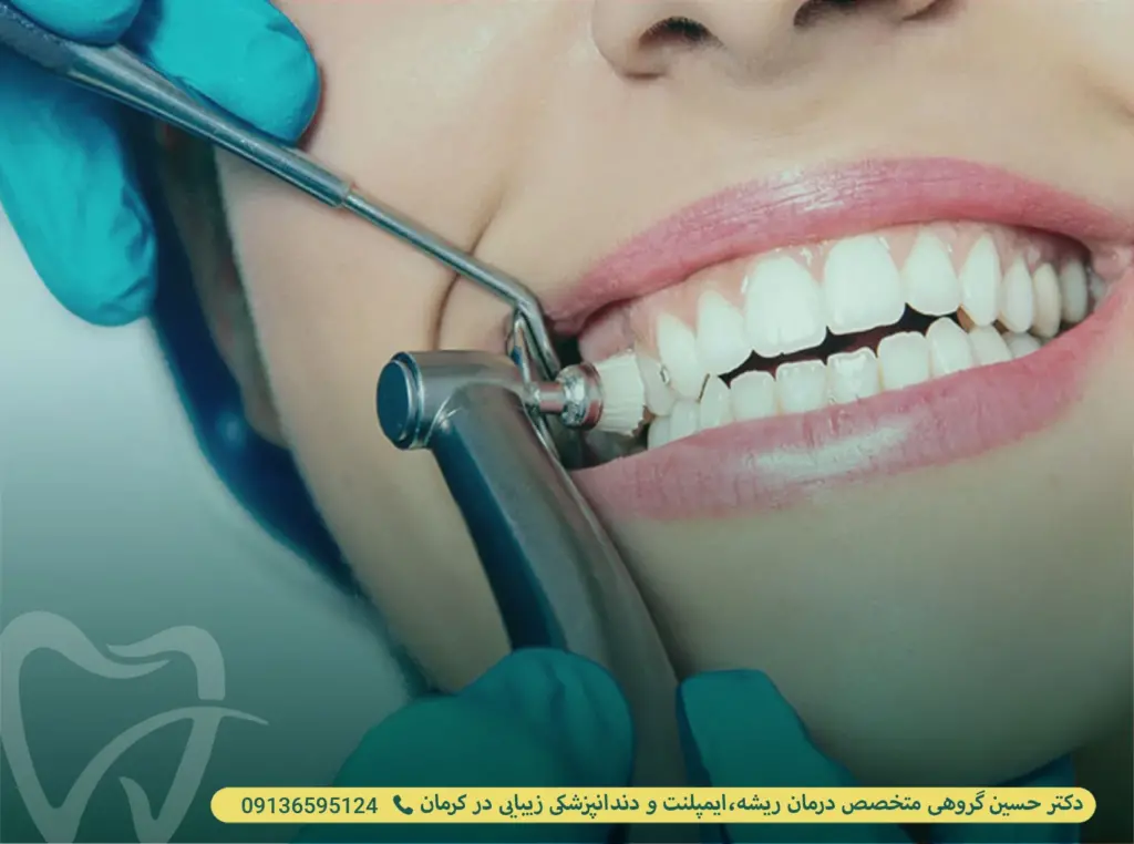 پولیش دندان در کرمان