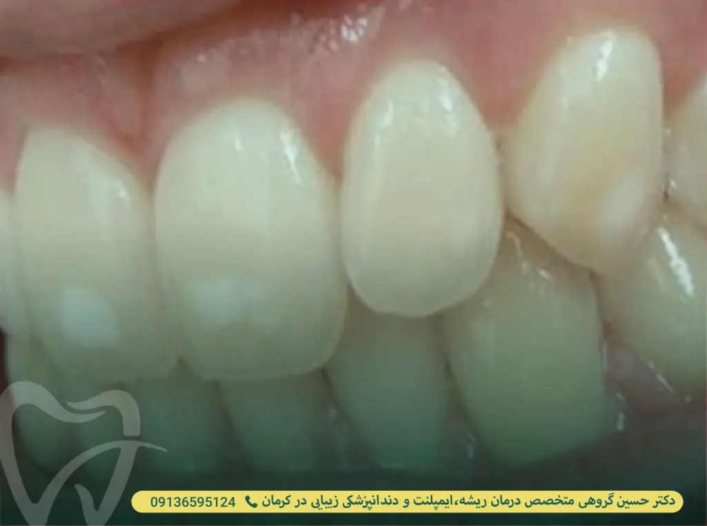 علت سفید شدن روی دندان ها