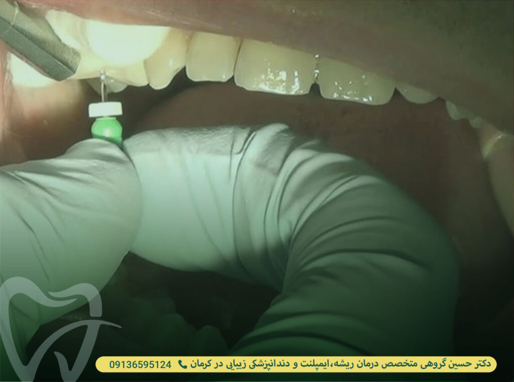 تشنج در دندانپزشکی