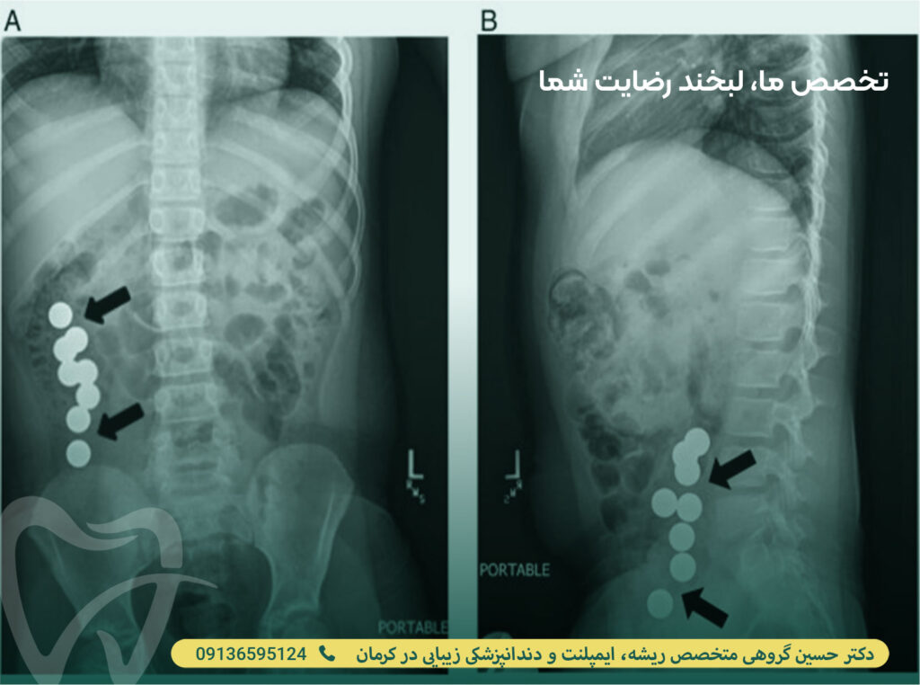 پیچ ایمپلنت در معده