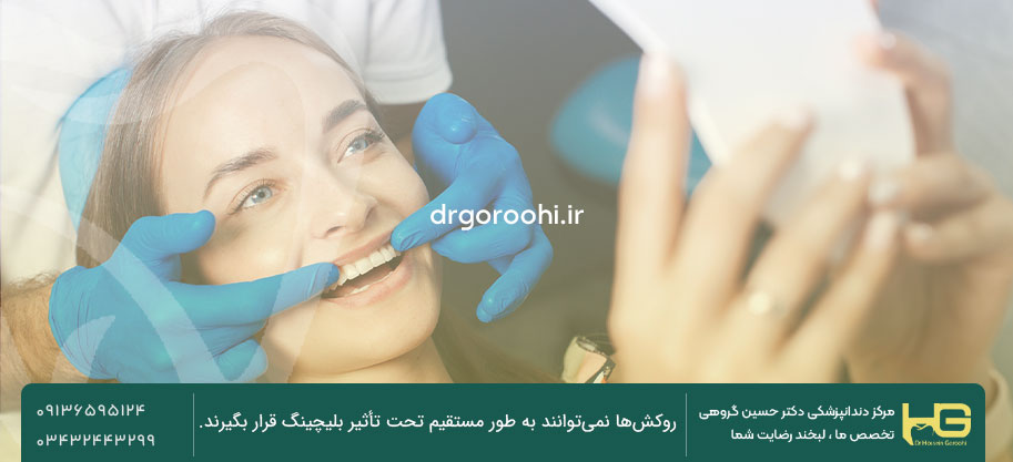 مزایای بلیچینگ دندان روکش شده