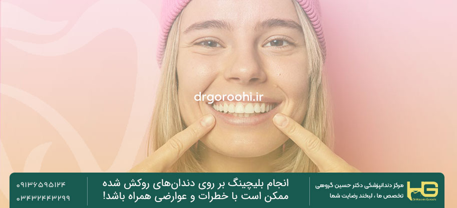 خطرات و عوارض احتمالی بلچینگ دندان روکش شده
