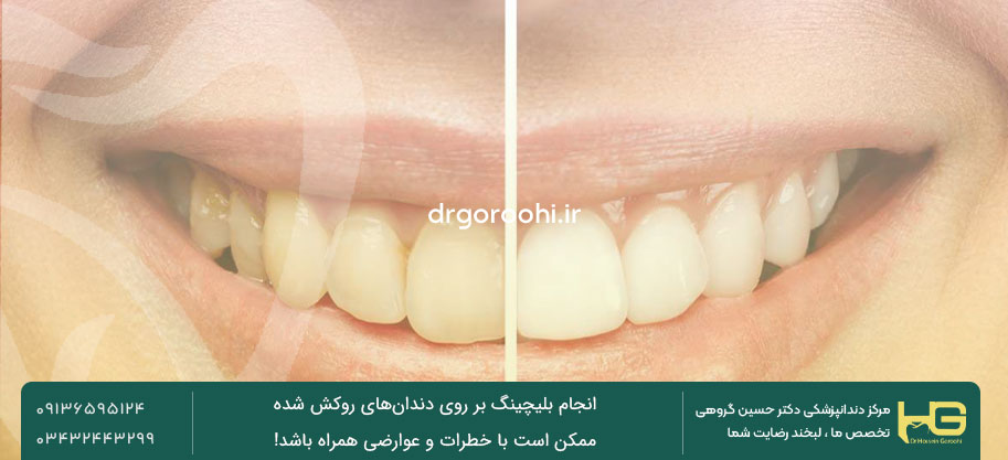 دلایل تغییر رنگ دندان ها