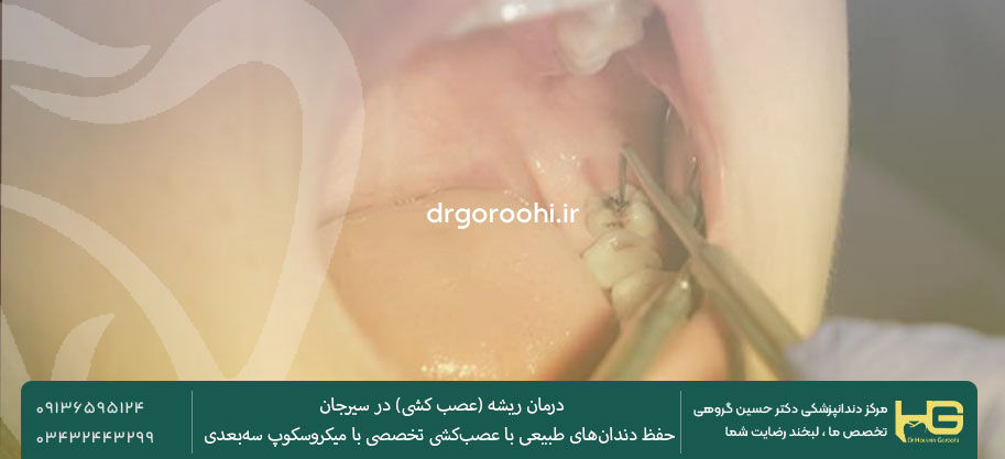 مراحل عصب کشی دندان در سیرجان توسط دکتر گروهی