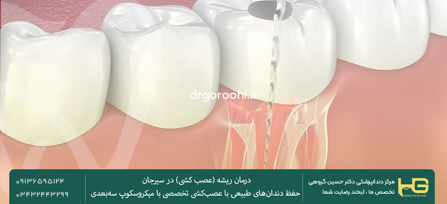 عصب کشی دندان در سیرجان