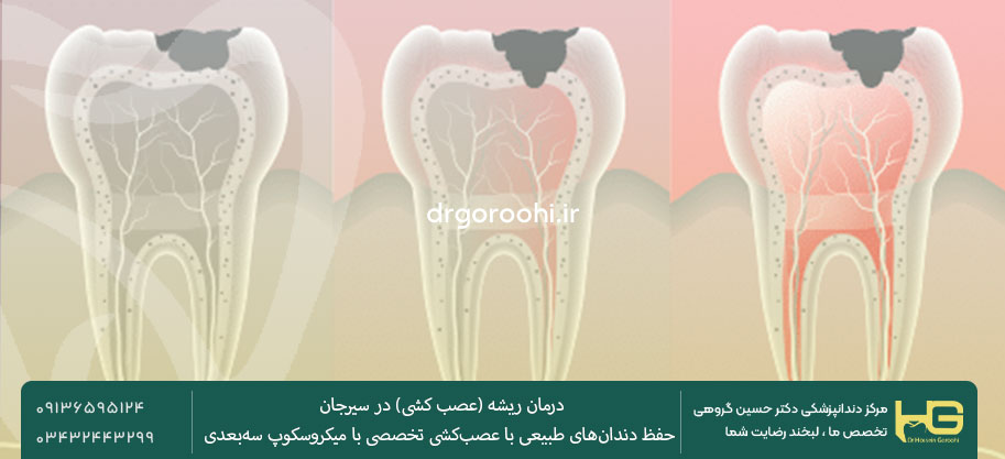 علائم آسیب ریشه دندان