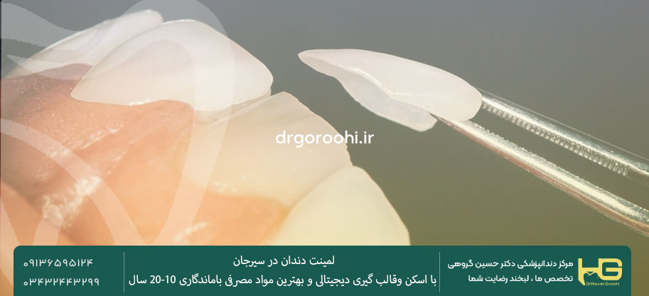 مراحل انجام لمینت دندان در سیرجان