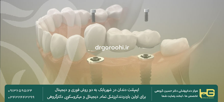 انجام ایمپلنت دندان در شهربابک