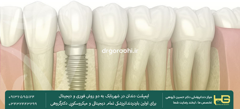 انجام ایپملنت دیجیتال نزد دکتر گروهی در شهربابک