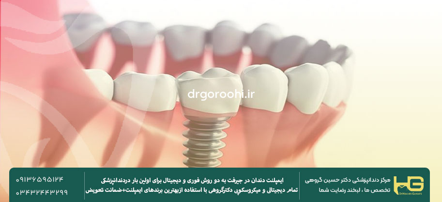 بهترین مرکز ایمپلنت دندان در جیرفت