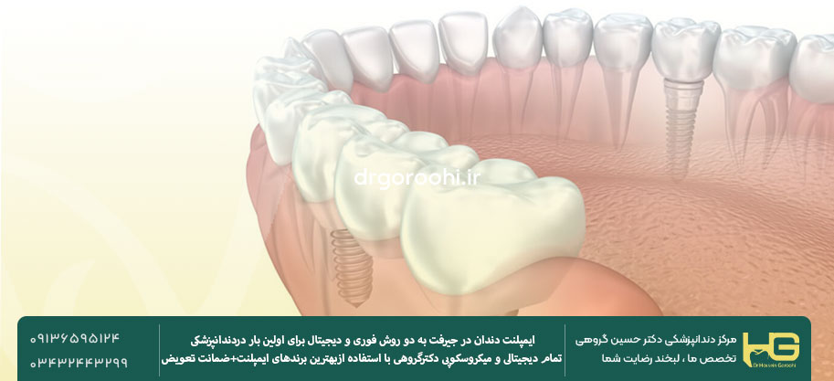 ایمپلنت دیجیتال در جیرفت
