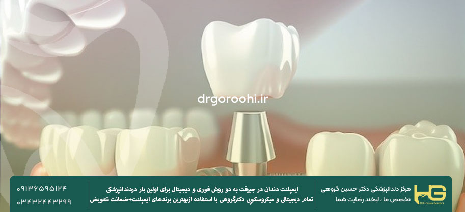 ایمپلنت دیجیتال دکتر گروهی در جیرفت