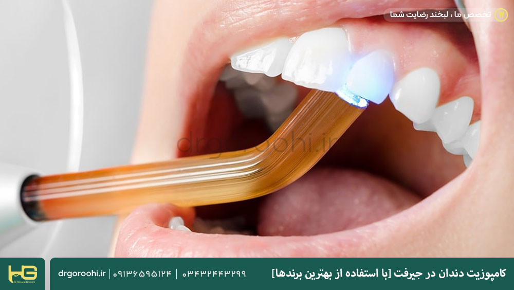 کامپوزیت دندان در جیرفت