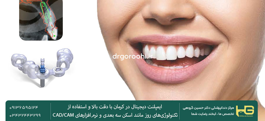 ایمپلنت دیجیتال ماندگاری بیشتری دارد