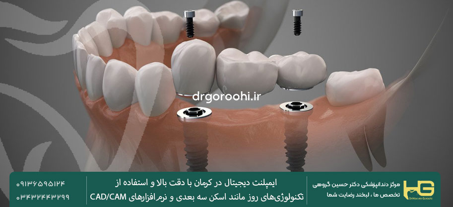 ایمپلنت دیجیتال طول عمر بیشتری دارد
