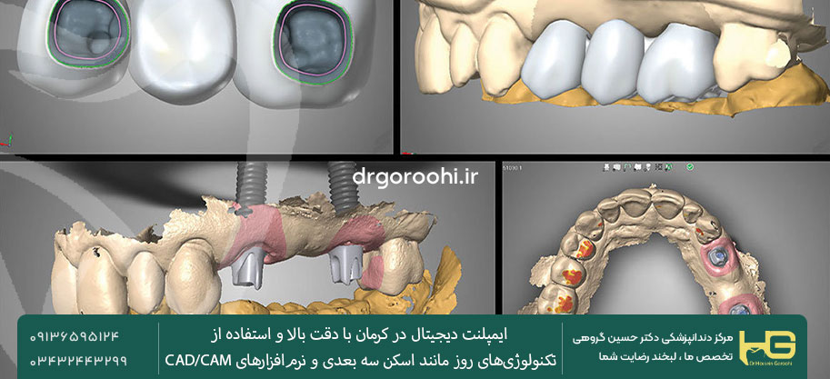 ایمپلنت دیجیتال دوام بیشتری دارد