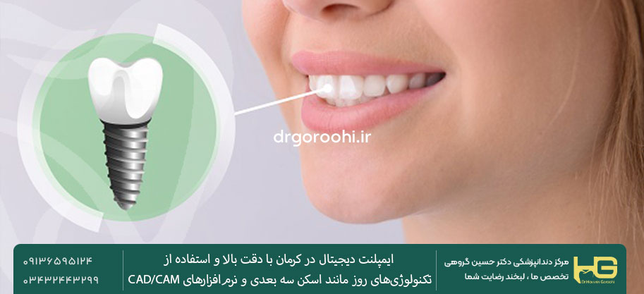 عوامل مؤثر بر طول عمر ایمپلنت دیجیتال