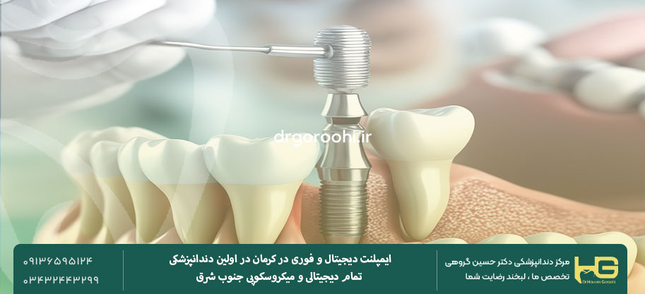 رعایت رژیم غذایی مناسب در سال اول پس از ایمپلنت