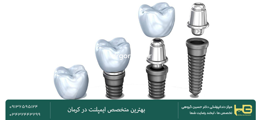 ایمپلنت دندان بدون جراحی