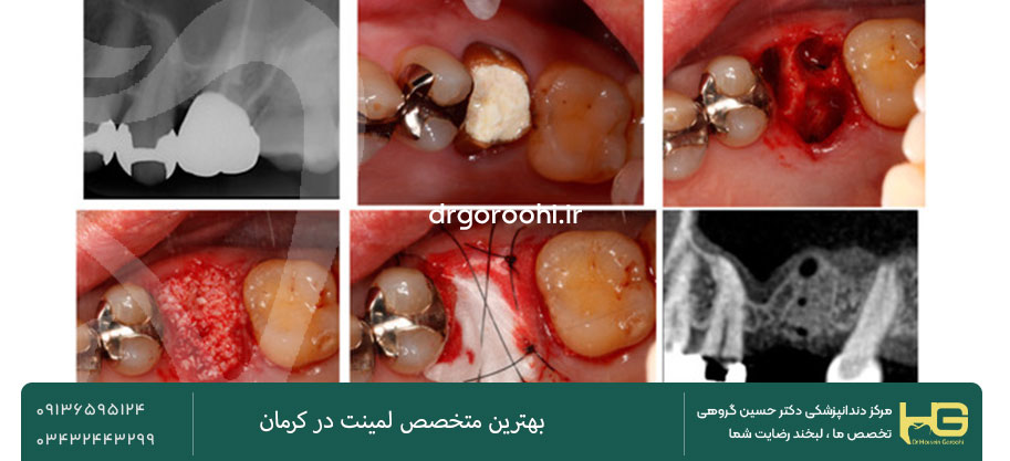 علائم شکست لمینت دندان