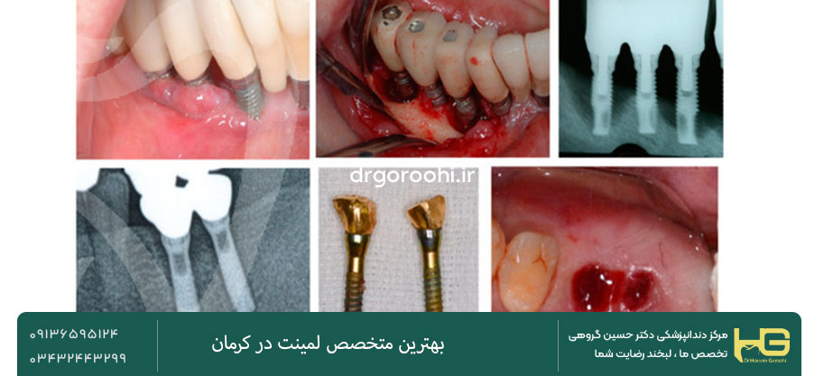 شکستن ایمپلنت در کرمان