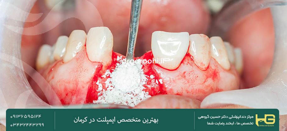 ایمپلنت دندان برای افراد با استخوان ضعیف