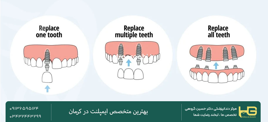  ایمپلنت تک‌دندان و چنددندان
