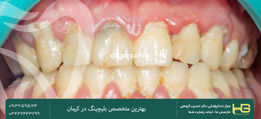 التهاب لثه