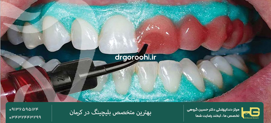 مراقبت های بعد از بلیچینگ دندان