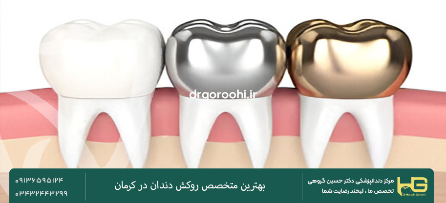 انواع روکش دندان
