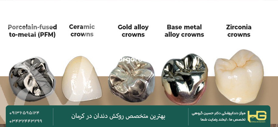 کدام روکش دندان بهتر است