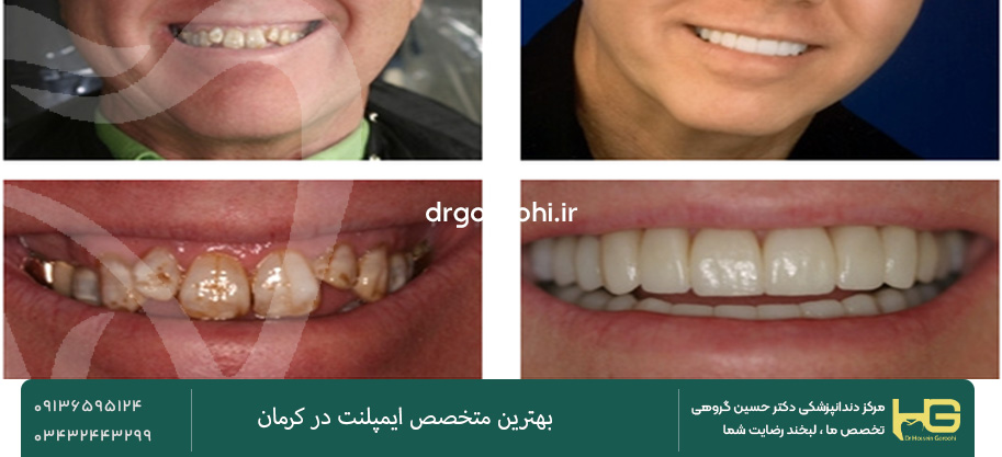 قبل و بعد از اوردنچر