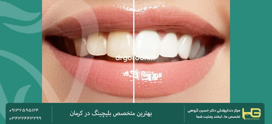 سفید کردن دندان در کرمان