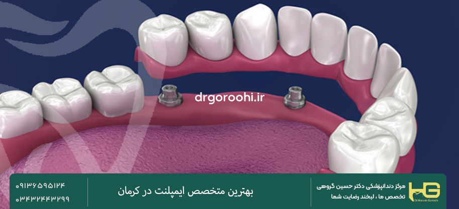  اوردنچرهای متکی بر ایمپلنت 