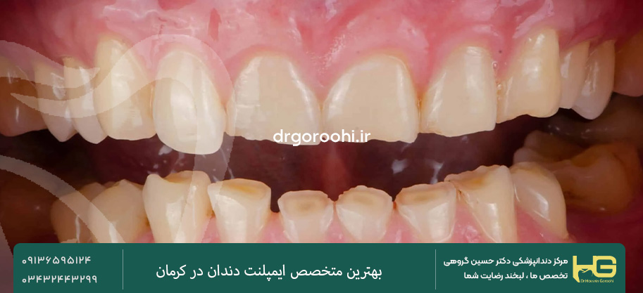 عصب کشی دندان برای براکسیسم ممکن است؟