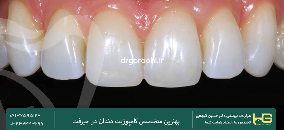 کامپوزیت دندان در جیرفت