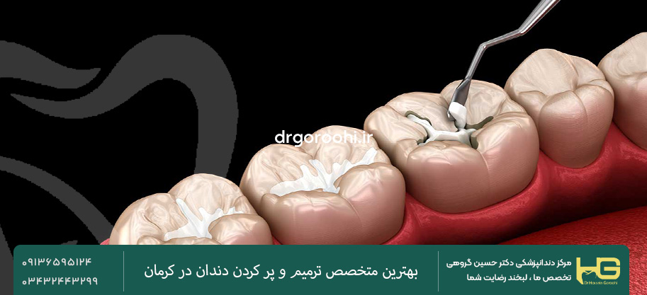 کدام نوع پر کردن دندان مناسب است